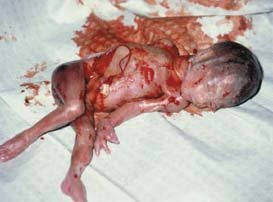 partial_birth_abortion